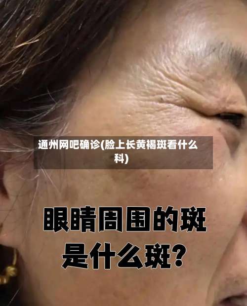通州网吧确诊(脸上长黄褐斑看什么科)-第2张图片