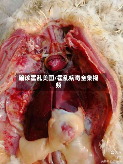 确诊霍乱美国/霍乱病毒全集视频