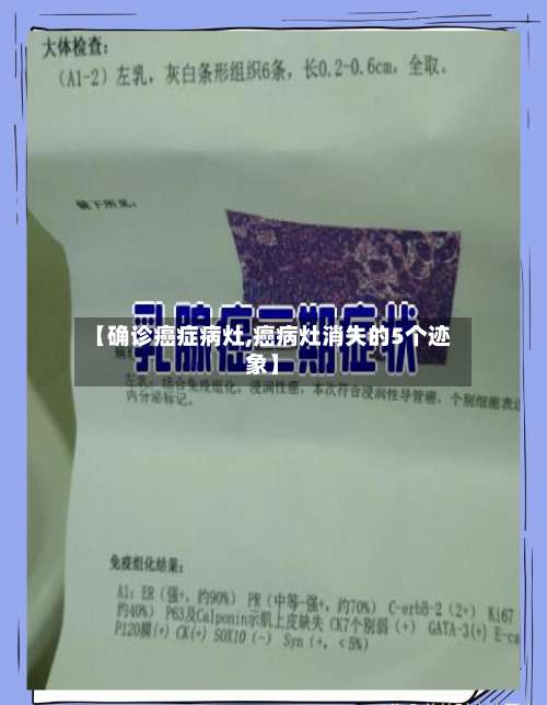 【确诊癌症病灶,癌病灶消失的5个迹象】
