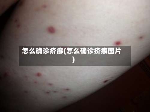 怎么确诊疥癣(怎么确诊疥癣图片)