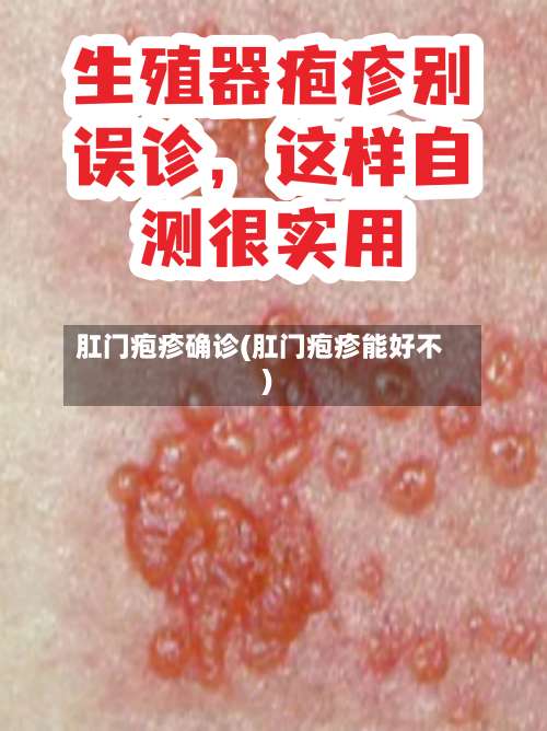 肛门疱疹确诊(肛门疱疹能好不)-第2张图片