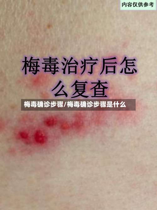 梅毒确诊步骤/梅毒确诊步骤是什么-第3张图片