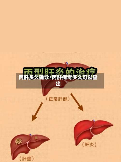 丙肝多久确诊/丙肝病毒多久可以查出-第3张图片