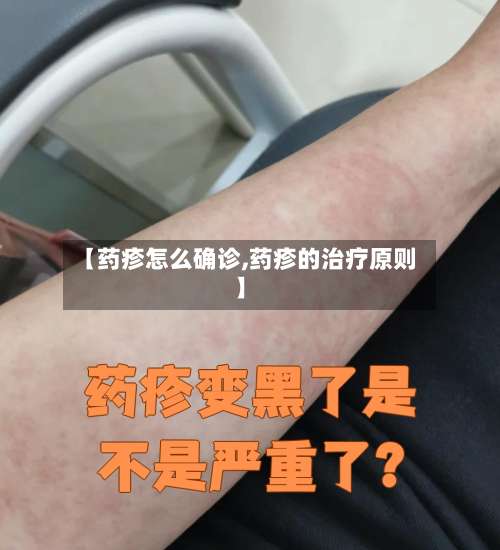 【药疹怎么确诊,药疹的治疗原则】-第2张图片