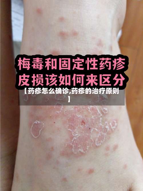 【药疹怎么确诊,药疹的治疗原则】